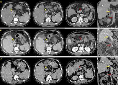 Case report: Rapid development of acute symptomatic portal vein system thrombosis after endoscopic variceal therapy in a patient with liver cirrhosis